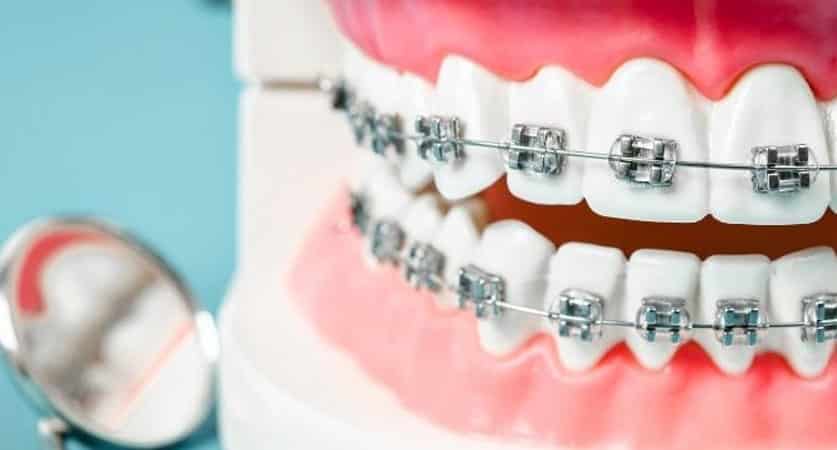 braces colors