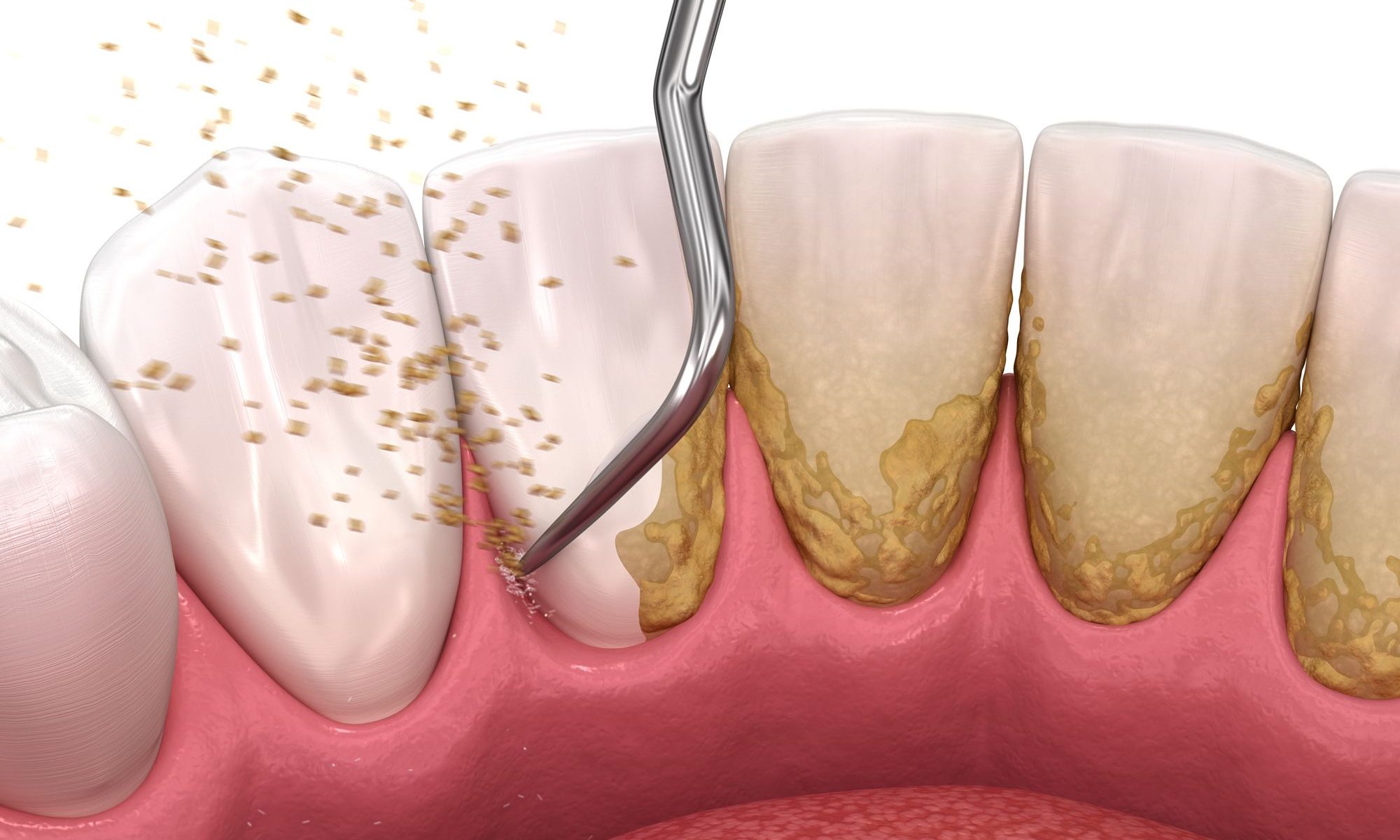 Periodontal Therapy