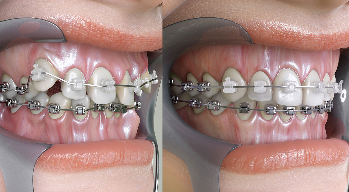 dental braces