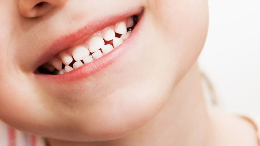 Teeth Whitening For children