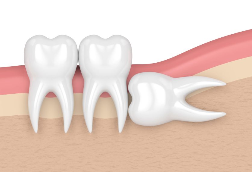 Wisdom Teeth Removal